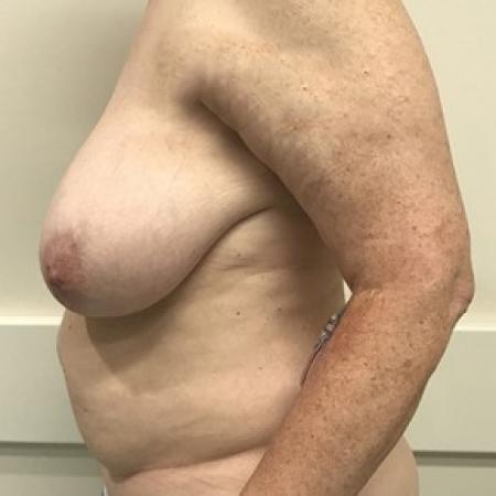 Before image 3 Case #87631 - DIEP Flap Breast Reconstrution