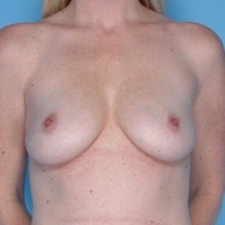 Before image 1 Case #79141 - Silicone 
