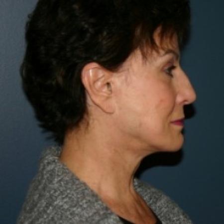 Before image 2 Case #81101 - Facelift