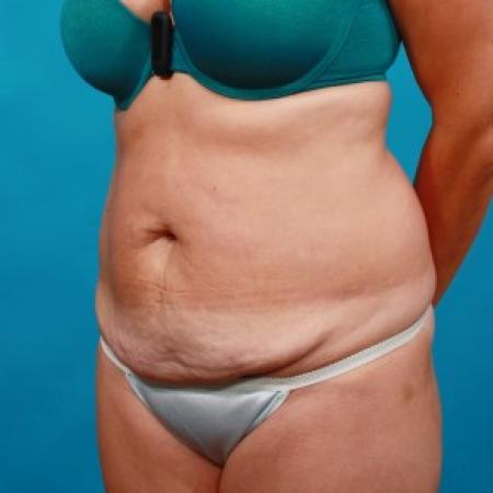 Before image 2 Case #85721 - Abdominoplasty with Flank Liposuction