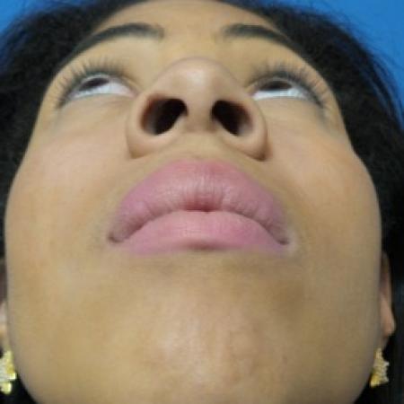Before image 3 Case #86446 - Rhinoplasty - 3 months post-op