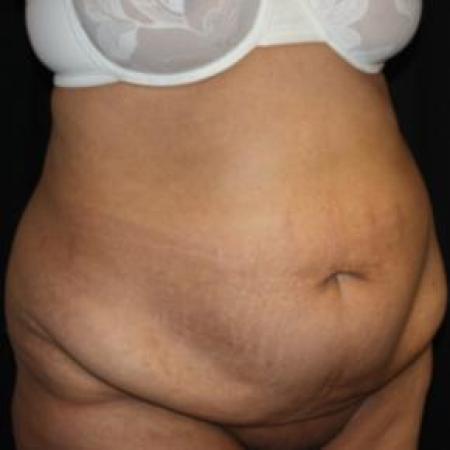 Before image 2 Case #85866 - Total Body Lift - 57 year old female