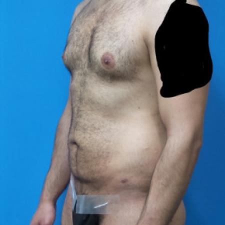 Before Case #88451 - Circumferential Body Lift /Gynecomastia Reduction