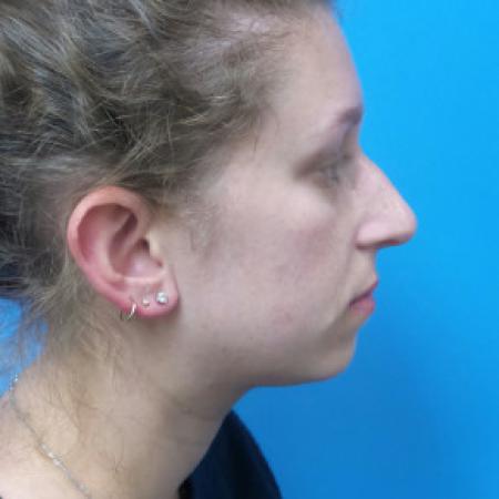 Before image 3 Case #88391 - 25 year old  -  Rhinoplasty/Septoplasty/Partial Turbinectomy  -  7 months post-op