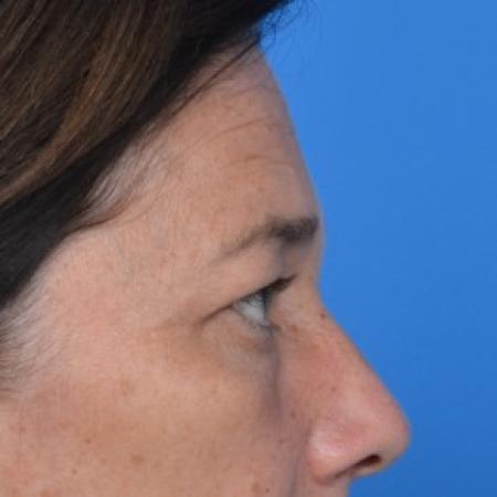 Before image 2 Case #87896 - Upper Eyelid Surgery (blepharoplasty)