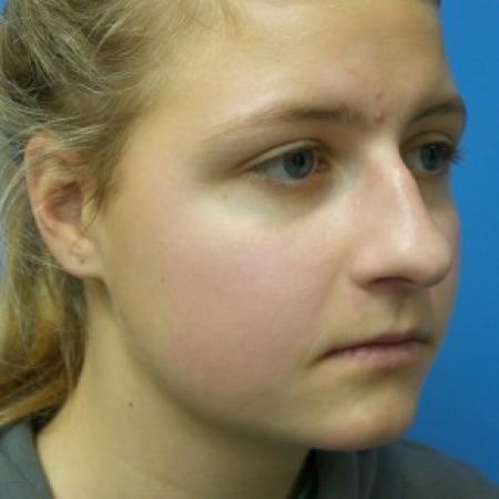 Before image 2 Case #87221 - 18 year old - Rhinoplasty/Septoplasty/Turbinectomy  -  5 months post-op