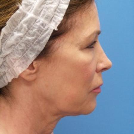 Before image 3 Case #86561 - Facelift/ Upper Blepharoplasty/Laser Resurfacing to Full Face     2 months post-op