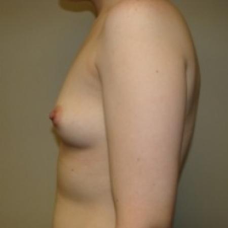 Before image 5 Case #79721 - Breast Augmentation