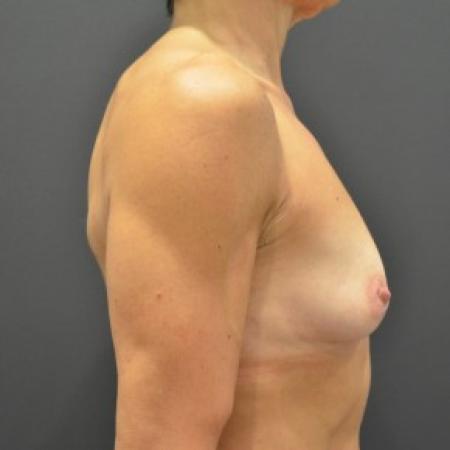Before image 3 Case #85781 - Breast Augmentation 