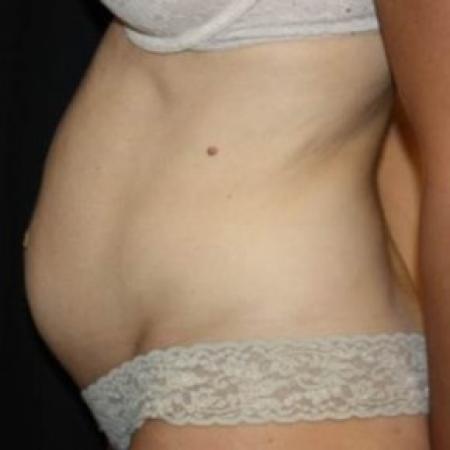 Before image 3 Case #84221 - Abdominoplasty, plication of rectus diastasis, ventral hernia repair - 35 year old female