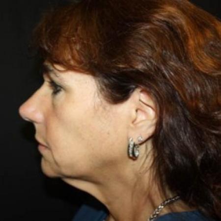 Before image 3 Case #85061 - Facelift and Neck Lift - 58 year old female