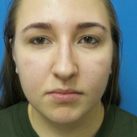 Before image 1 Case #88316 - 19 year old  -  Open Rhinoplasty  -  6 months post-op