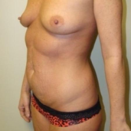 Before image 2 Case #79036 - Tummy Tuck