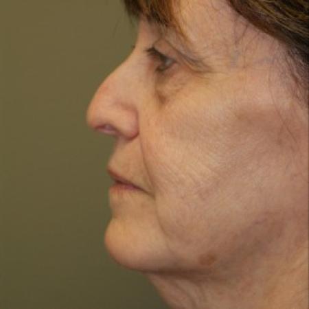 Before image 3 Case #81916 - Facelift