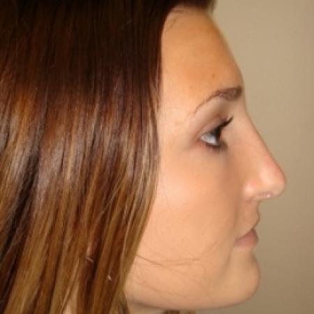 Before image 2 Case #79961 - Open Rhinoplasty