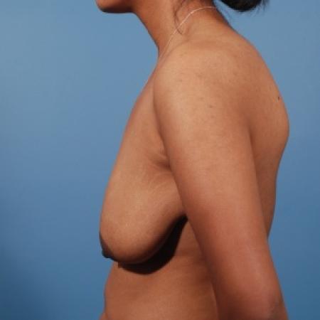Before image 3 Case #79981 - Breast Lift