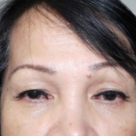 Before image 1 Case #82481 - Upper Blepharoplasty
