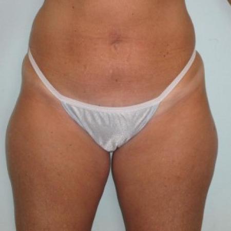 Before image 1 Case #82731 - Liposculpture - hips and thighs