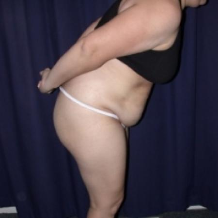 Before image 3 Case #79816 - Tmmy Tuck/ Lipo-Abdominoplasty