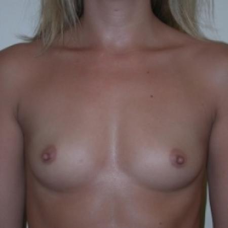 Before image 1 Case #80666 - Breast Augmentation