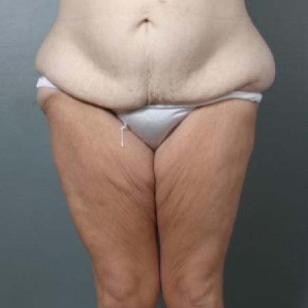 Before Case #83316 - Lower Body Lift after Massive Weight Loss