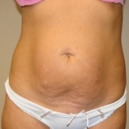 Before image 1 Case #80116 - Abdominoplasty