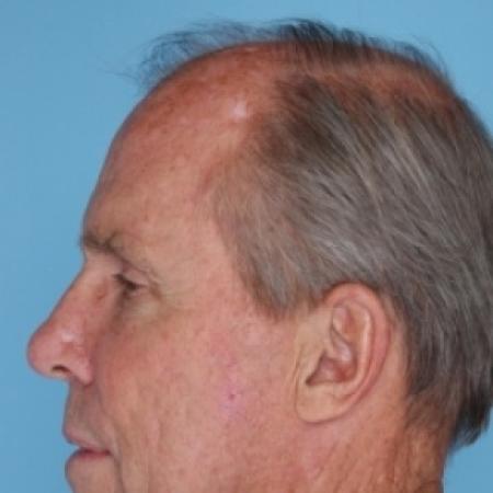 Before image 3 Case #79681 - Facelift