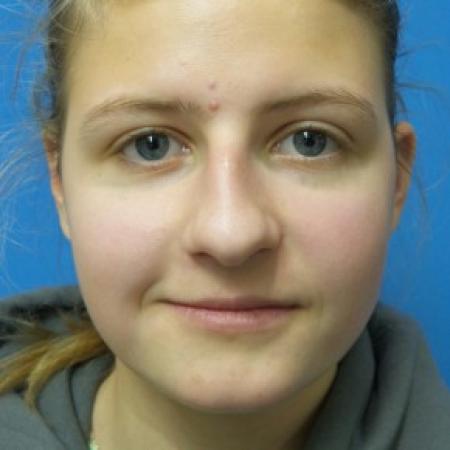 Before image 1 Case #87221 - 18 year old - Rhinoplasty/Septoplasty/Turbinectomy  -  5 months post-op