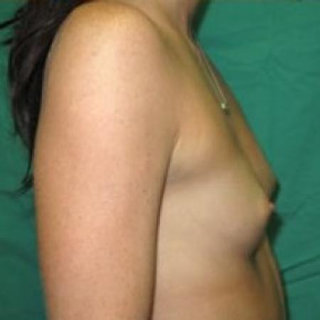 Before image 3 Case #85791 - Breast Augmentation 