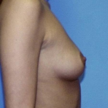 Before image 2 Case #79081 - Saline Breast Implants