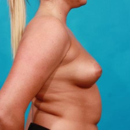 Before image 3 Case #84031 - Silicone Breast Augmentation