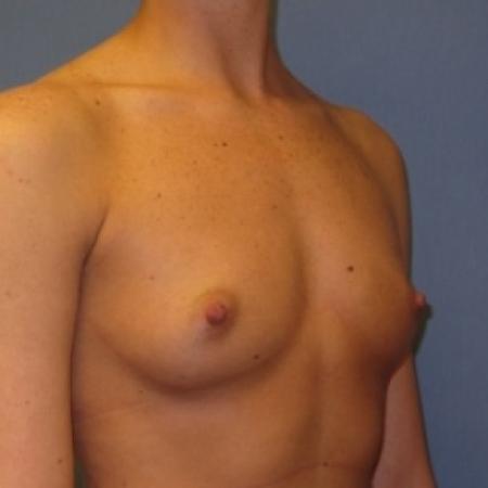 Before image 2 Case #80676 - Breast Augmentation
