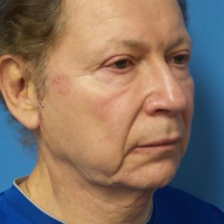 Before image 2 Case #86571 - Facelift/Chin Augmentation with Implant     7 months post-op