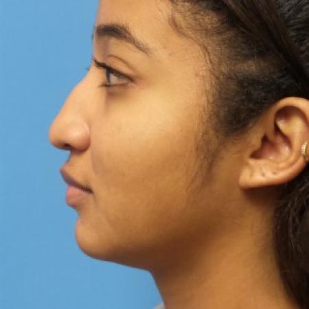 Before image 3 Case #86471 - Rhinoplasty/Septoplasty/Turbinectomy - 1 year post-op