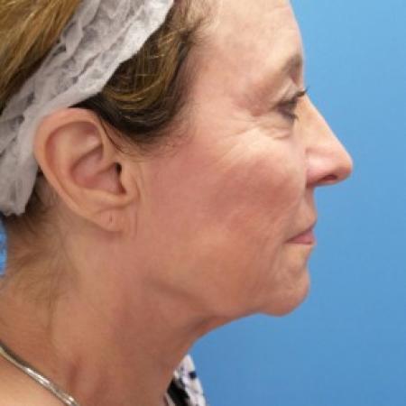 Before image 3 Case #87181 - 68 year old  -  Facelift  -  3 months post-op