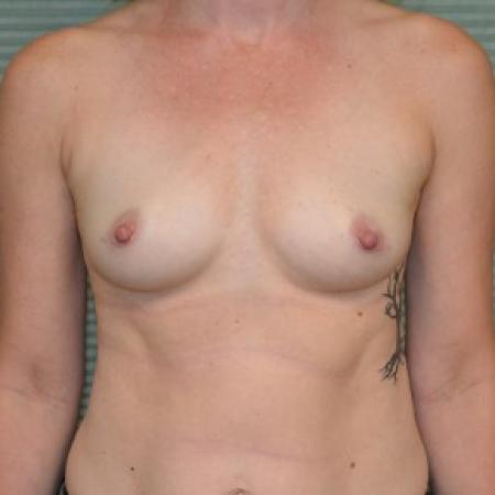 Before image 1 Case #87806 - Breast Augmentation with Mentor MemoryGel Smooth Round Moderate Plus Profile 325cc gel breast implants.