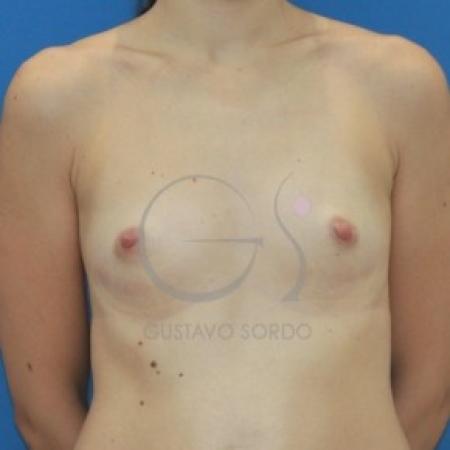 Before image 1 Case #87636 - Anatomical breast augmentation