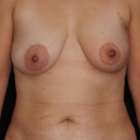 Before image 1 Case #82931 - 57 y/o - Immediate Unilateral Left DIEP Flap Breast Reconstruction