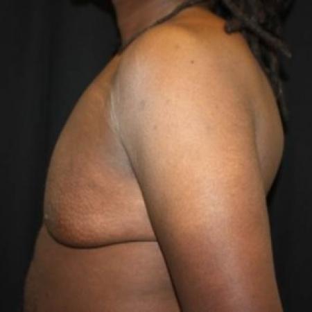 Before image 3 Case #83056 - 22 year old Gynecomastia