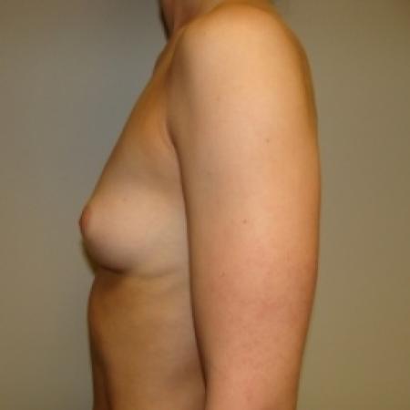 Before image 3 Case #79526 - Breast Augmentation