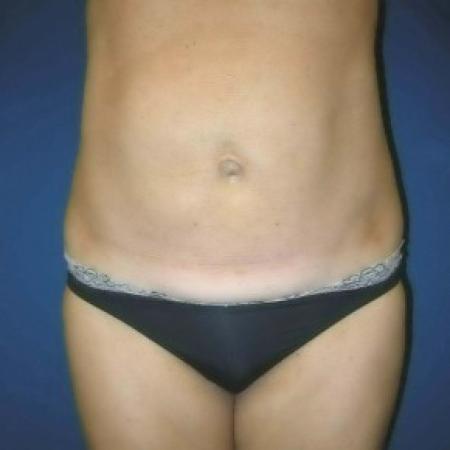 Before image 1 Case #82821 - Tummy Tuck and Liposuction of Hips