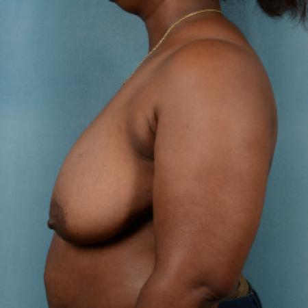 Before image 3 Case #88156 - 39 year old female desires smaller breasts.
