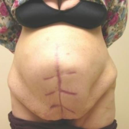 Before image 1 Case #81141 - Abdominoplasty with ventral hernia repair