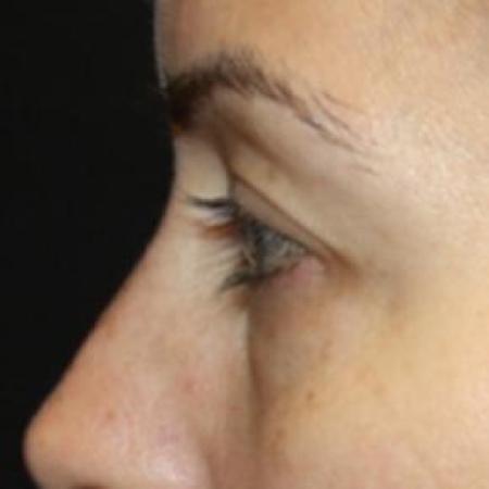 Before image 3 Case #85846 - Blepharoplasty - Upper and Lower Lids - 42 year old female