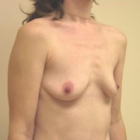 Before image 3 Case #81026 - Breast Augmentation