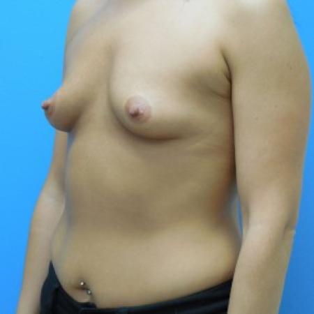 Before image 2 Case #81841 - Breast Augmentation