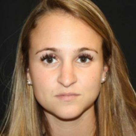 Before image 1 Case #84211 - Rhinoplasty - 24 year old female.