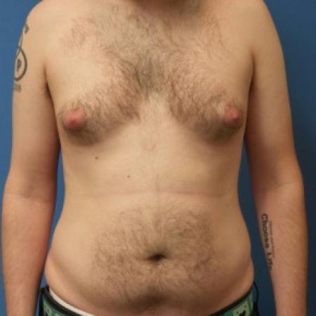 Before image 1 Case #86406 - Gynecomastia