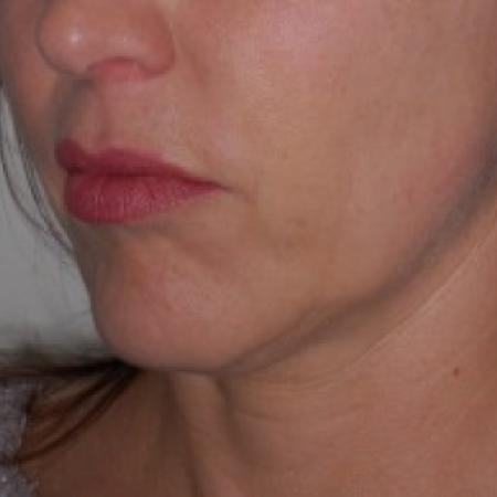 Before image 1 Case #87216 - Chin Implant