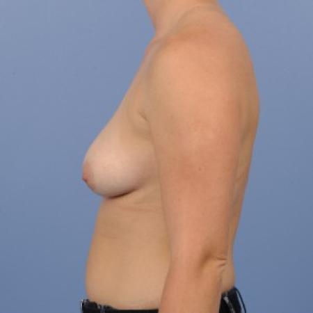 Before image 2 Case #87351 - Breast Augmentation in 27 year-old